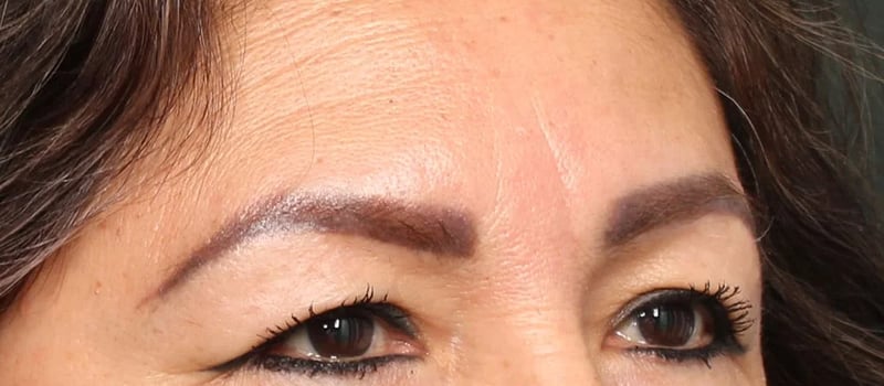 Upper Blepharoplasty Before & After Image