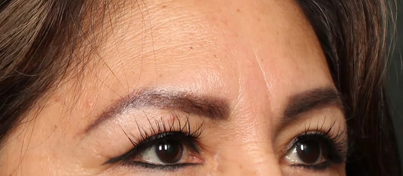 Upper Blepharoplasty Before & After Image