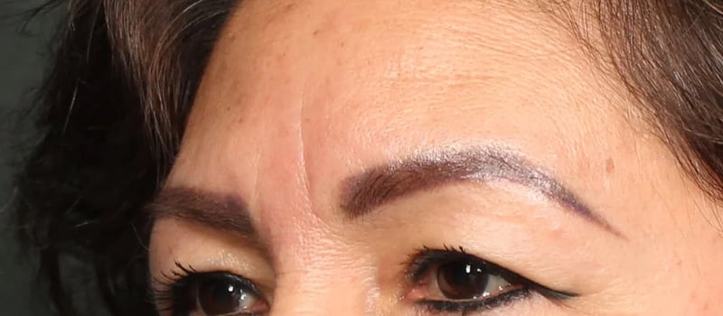 Upper Blepharoplasty Before & After Image