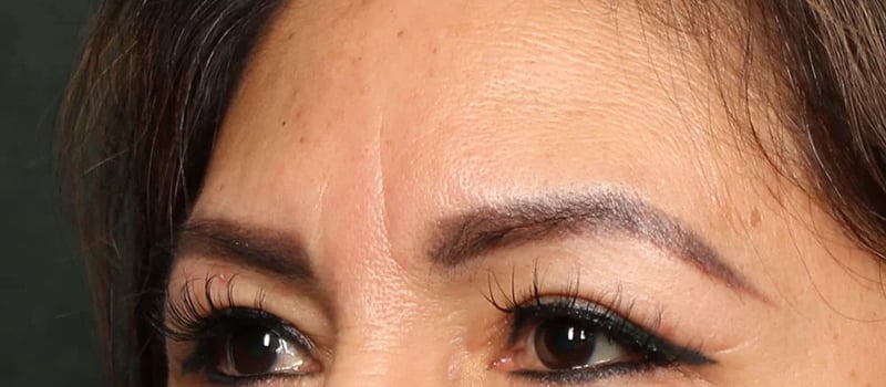 Upper Blepharoplasty Before & After Image